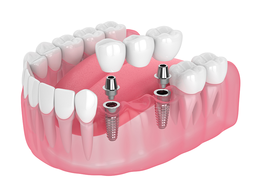 This is a thumbnail image of blog Restoring Your Smile with Dental Implant Restorations in Stamford, CT This is a thumbnail image of blog Restoring Your Smile with Dental Implant Restorations in Downtown Stamford, CT