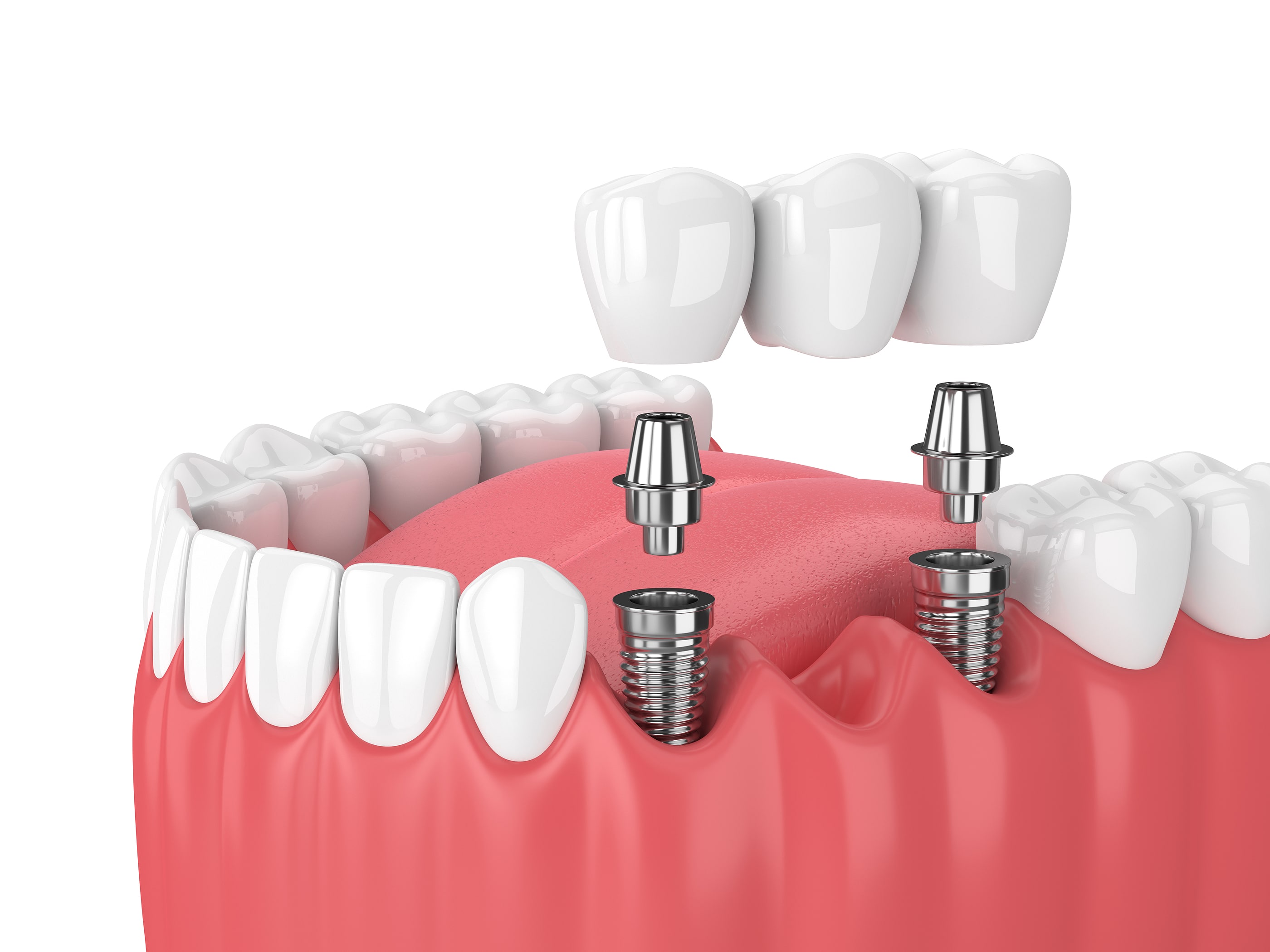Dental_Implant_Restorations Dental_Implant_Restorations