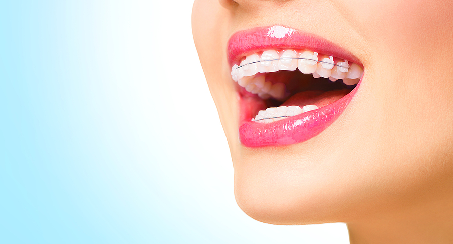 teeth whitening in Stamford, CT  teeth whitening in Stamford, CT