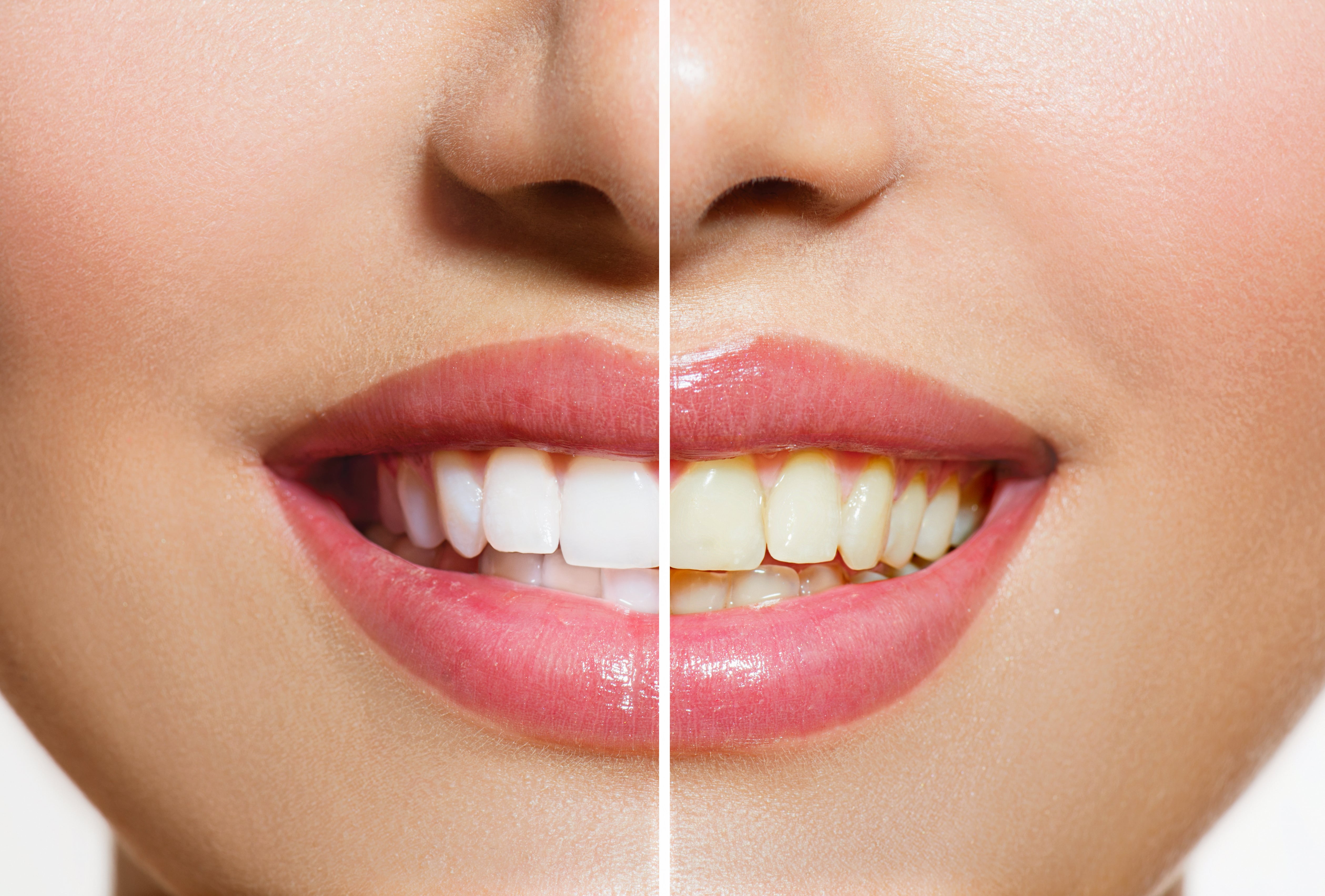 Teeth_whitening Teeth_whitening